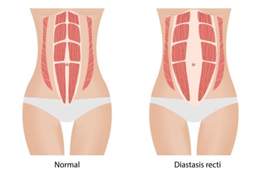 Diastasis abdominal