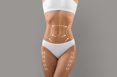 Torso de mujer con liposucción