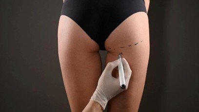 Gluteoplastia con implantes