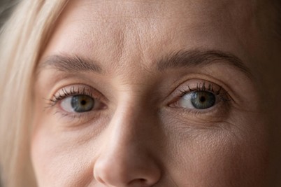 Mujer después de recuperación de una blefaroplastia